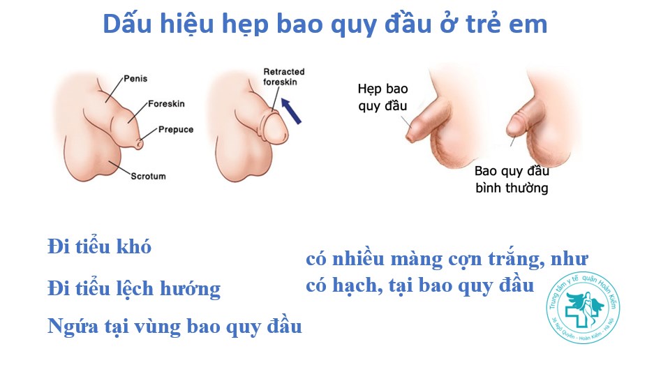 Dấu hiệu hẹp bao quy đầu ở trẻ em